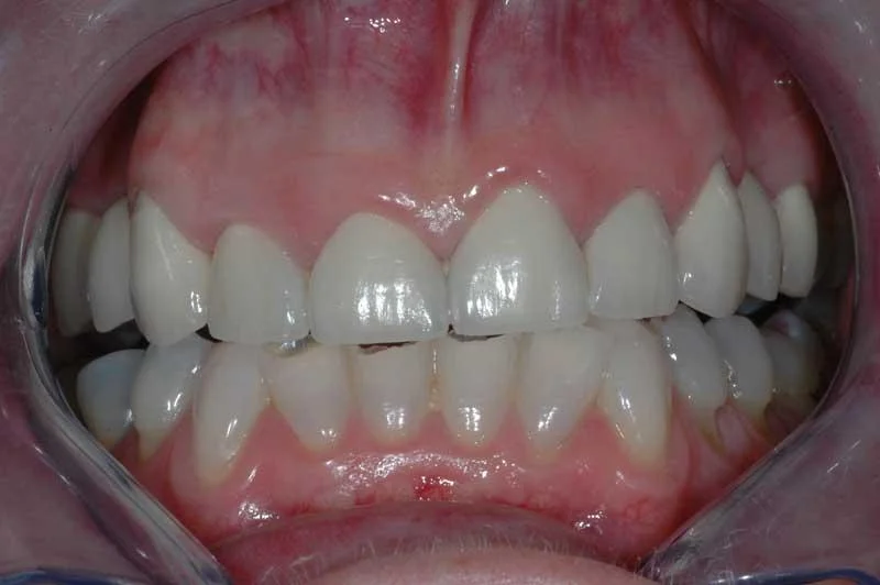 Porcelain crowns and 2 bridges