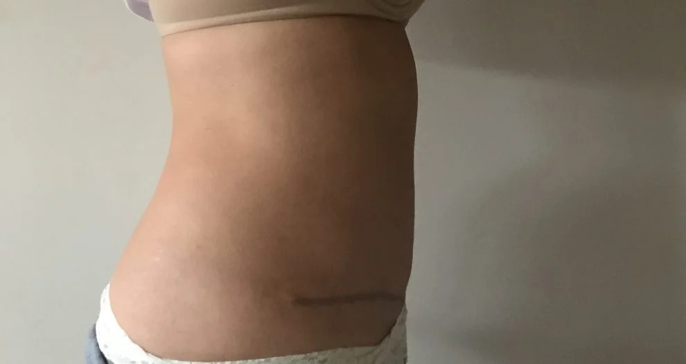 After – on the flat side but still swollen. You can see my scar at the bottom has started to go purple, part of the healing process.