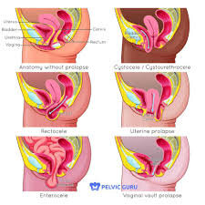 Pregnant Prolapse