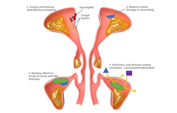 A graphic showing the causes of chronic rhinosinusitis.