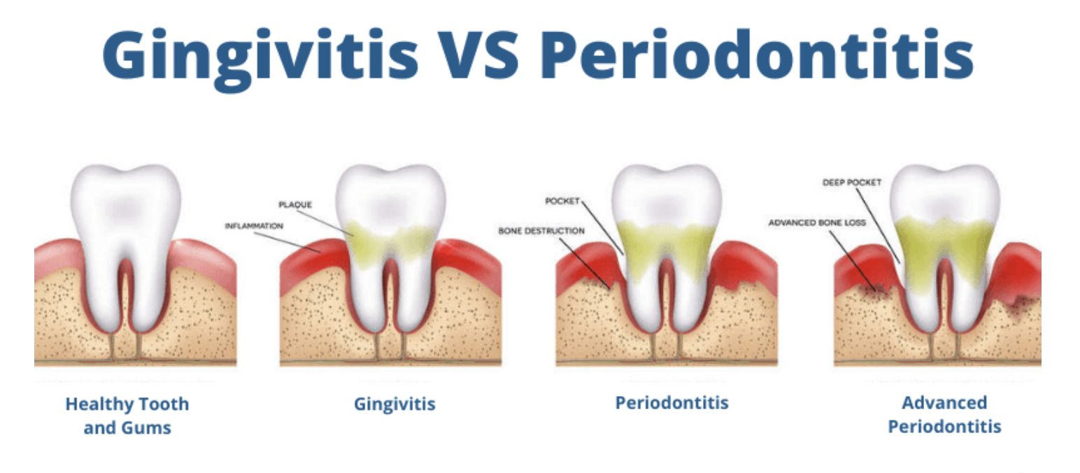 An image comparing gingivitis and periodontitis, highlighting the importance of oral health and overall health.