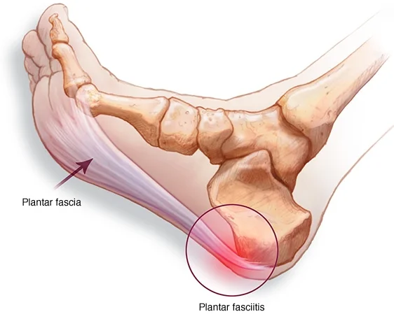 https://www.roddsanchez.com.au/2017/03/plantar-fasciitis-heel-pain/