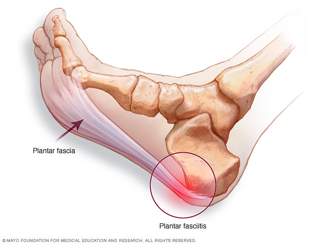 Plantar Fasciitis - A Pain In The Foot!!