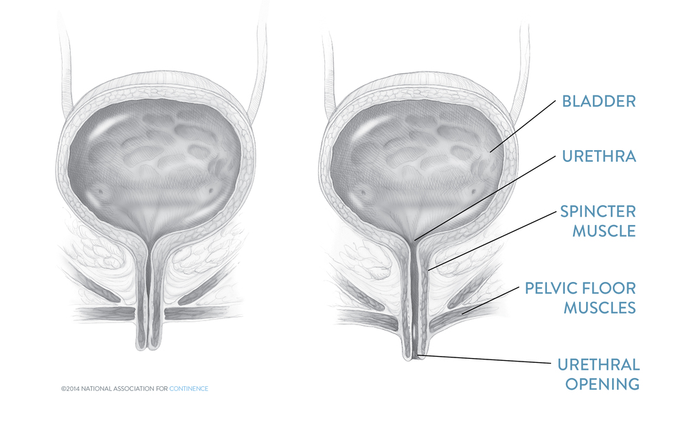 Female Stress Incontinence Procedures - National Association For