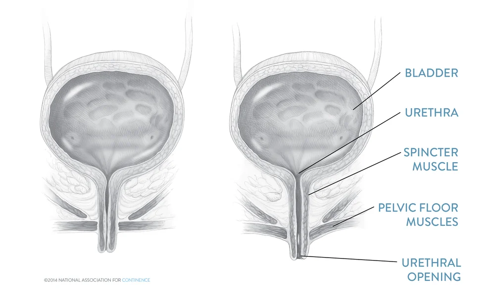 Female Stress Incontinence Procedures - National Association For Continence