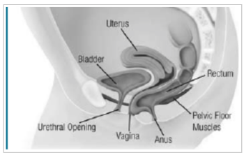 Rectocele (Prolapsed Rectum)