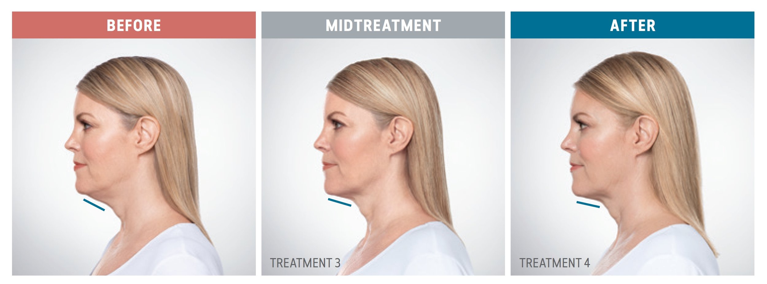 Kybella.jpeg