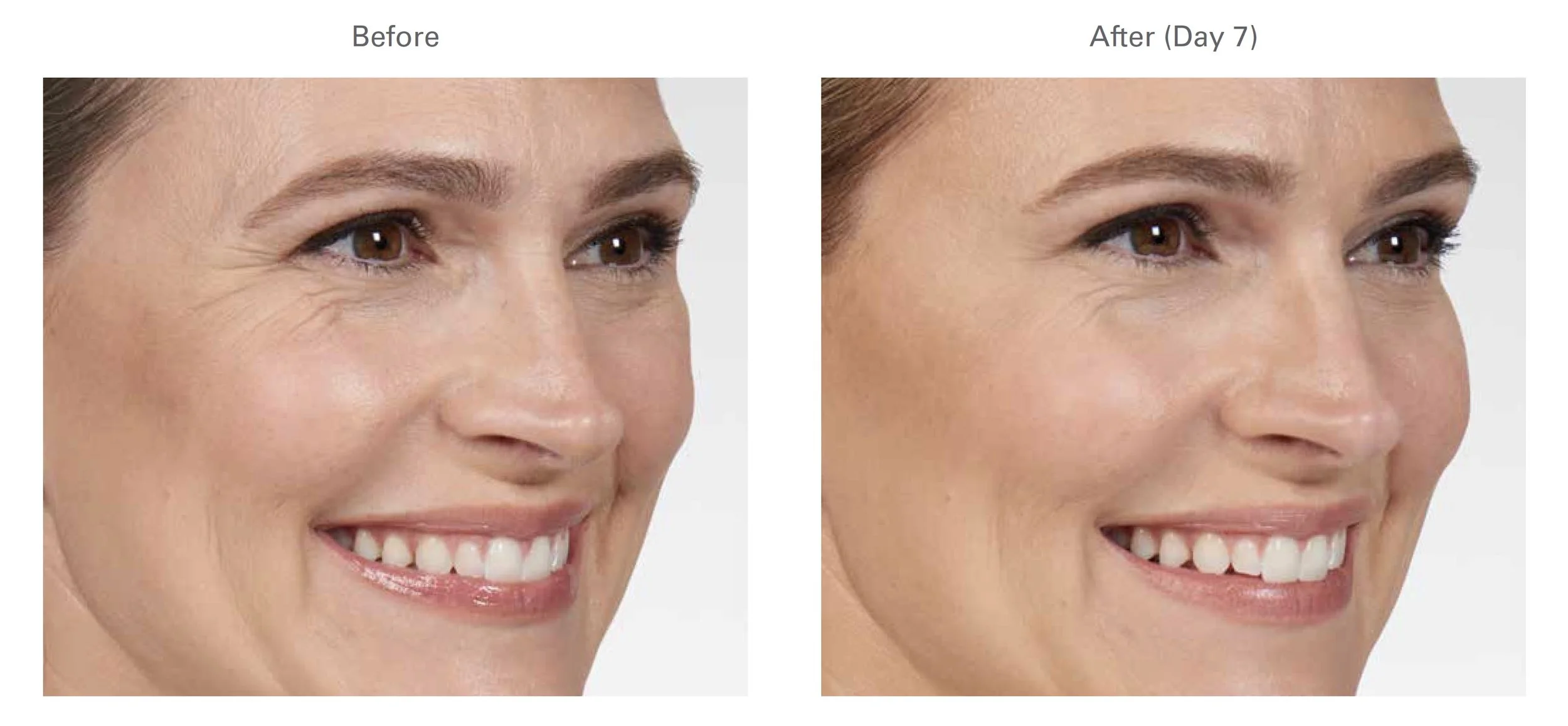 botox.jpeg