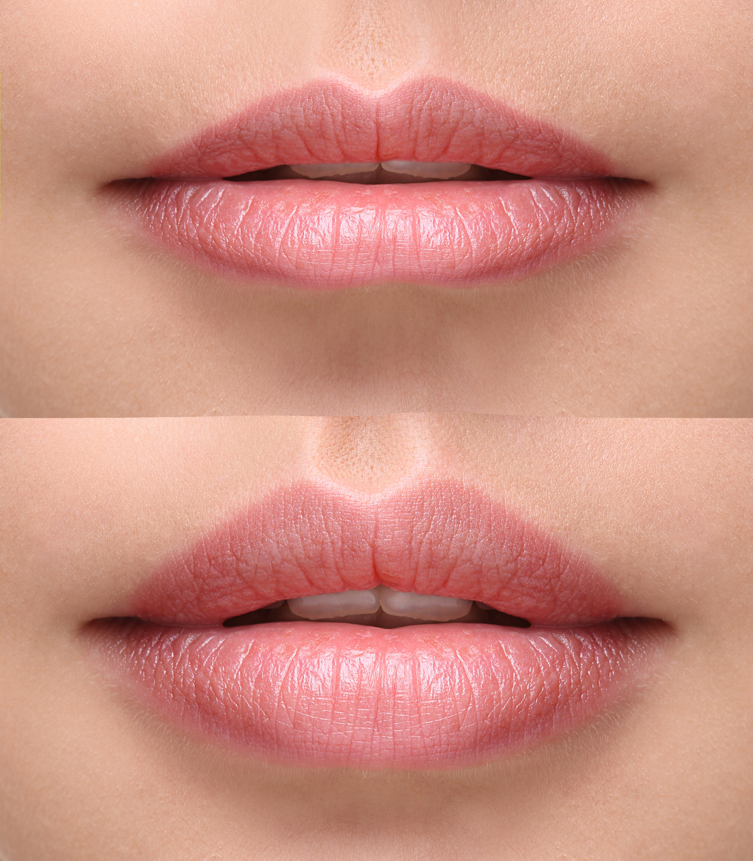 Sexy plump lips after filler injection