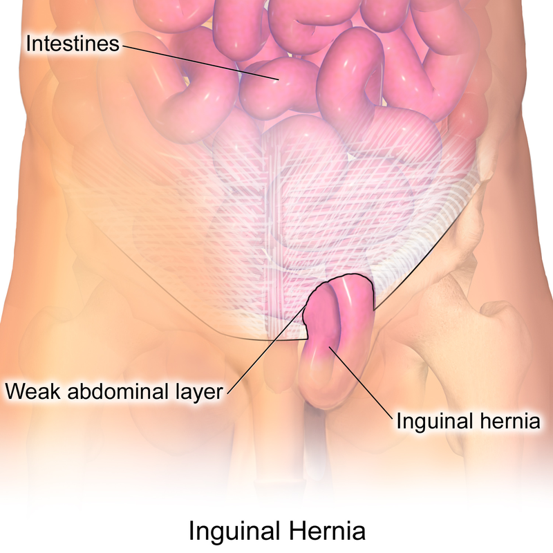 Blausen_0560_InguinalHernia.png