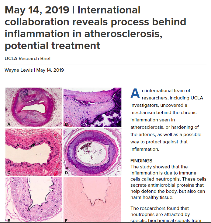  International collaboration reveals process behind inflammation in atherosclerosis, potential treatment