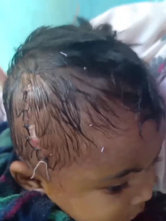 18month child suffered severe head injury during conflict SFH medics patched up child gave supplies from budget and drove him to a clinic for further treatment.png