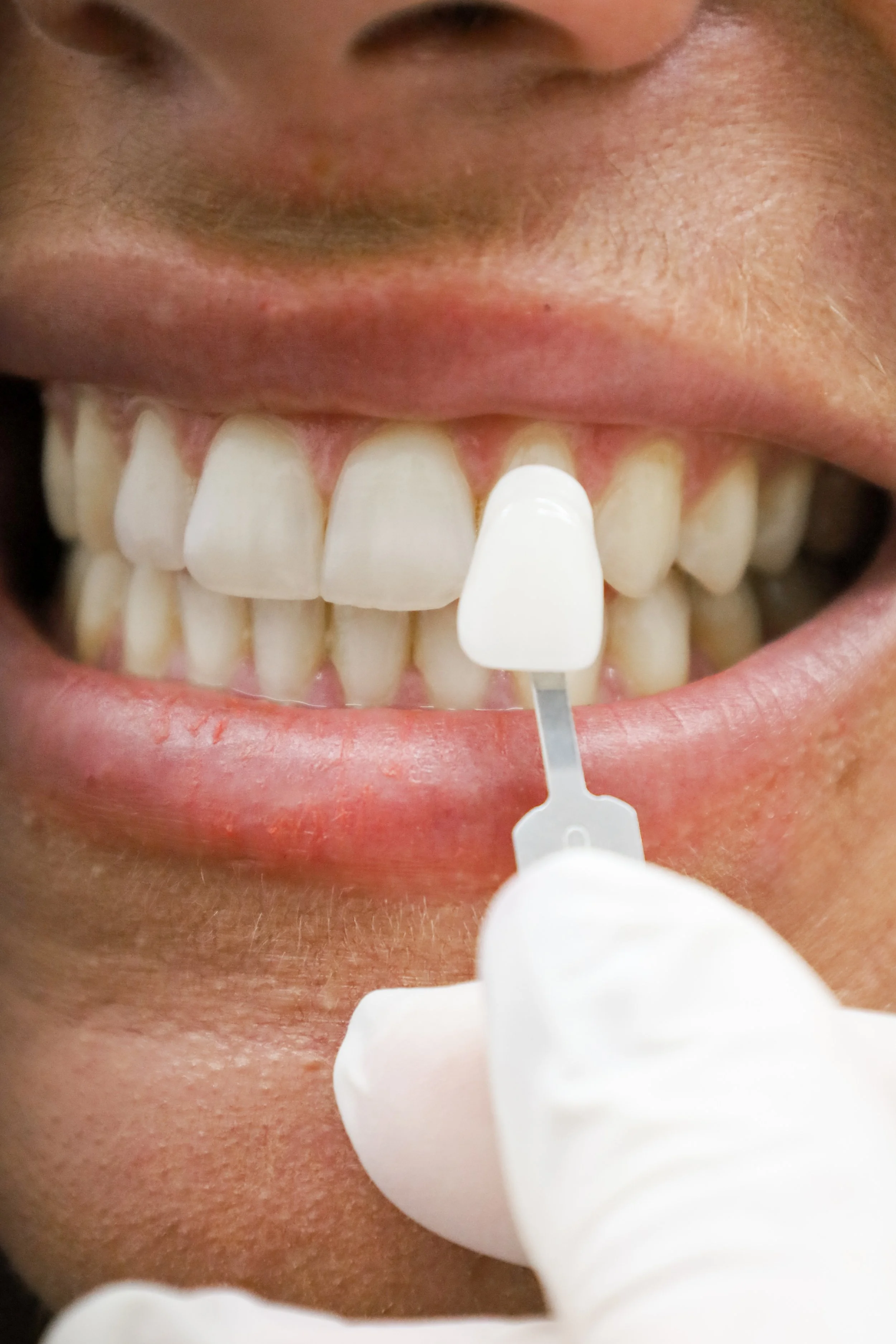 Denture with color sample for dental prosthesis.