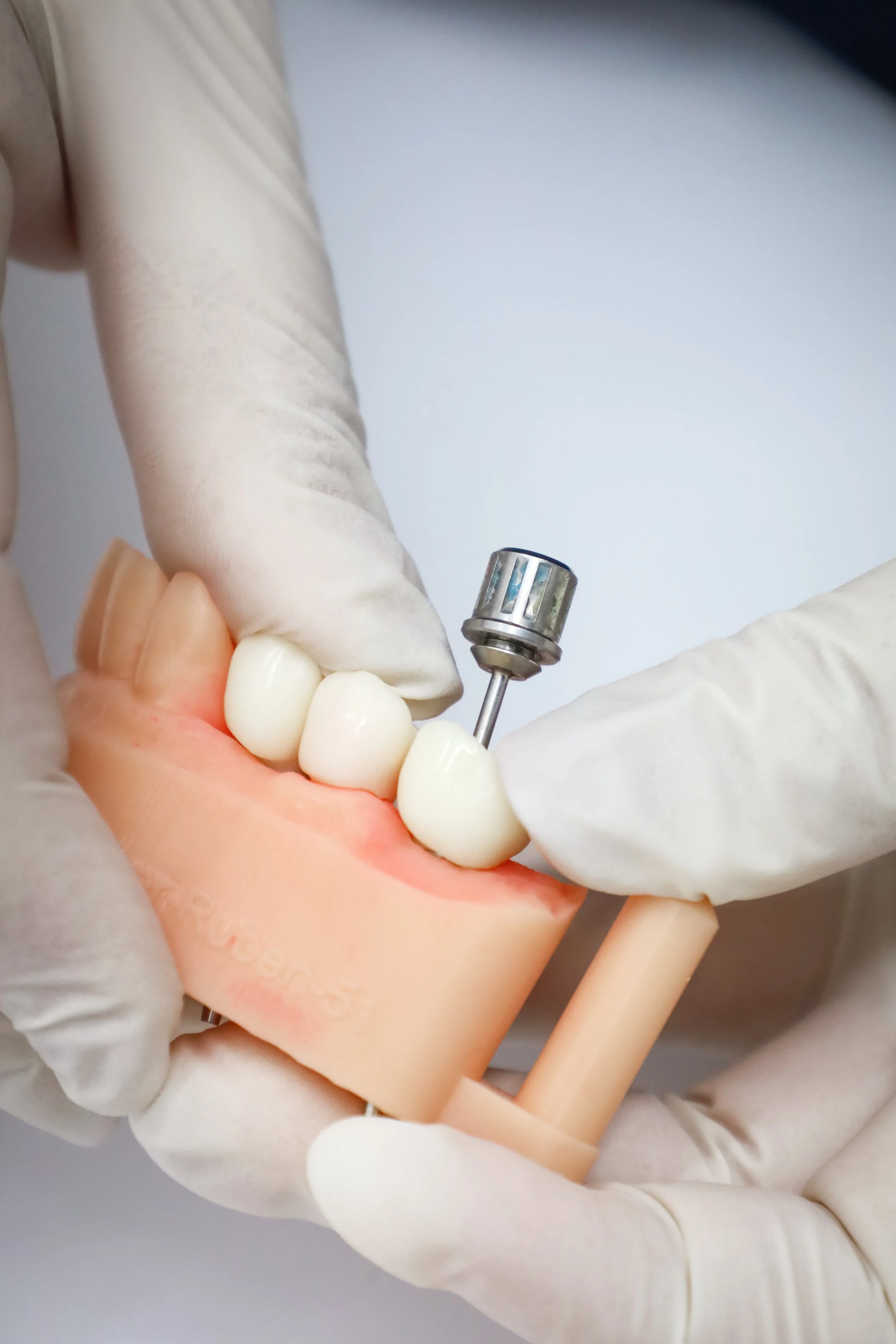 Dentista ajustando coronas dentales en un modelo dental, usando guantes blancos y una herramienta dental.