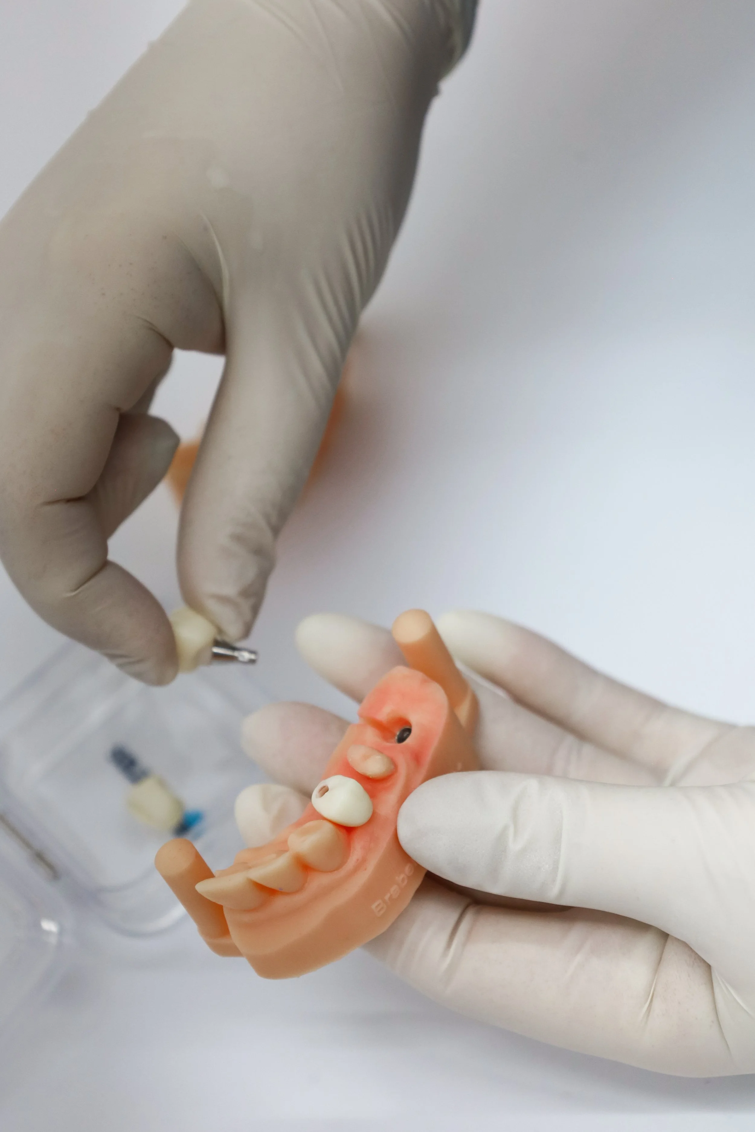 Tipos de implantes dentales: diferencias, materiales y cómo elegir el ideal 