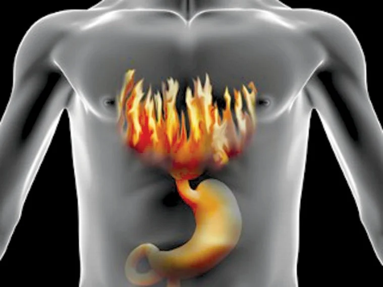 acidreflux.jpg
