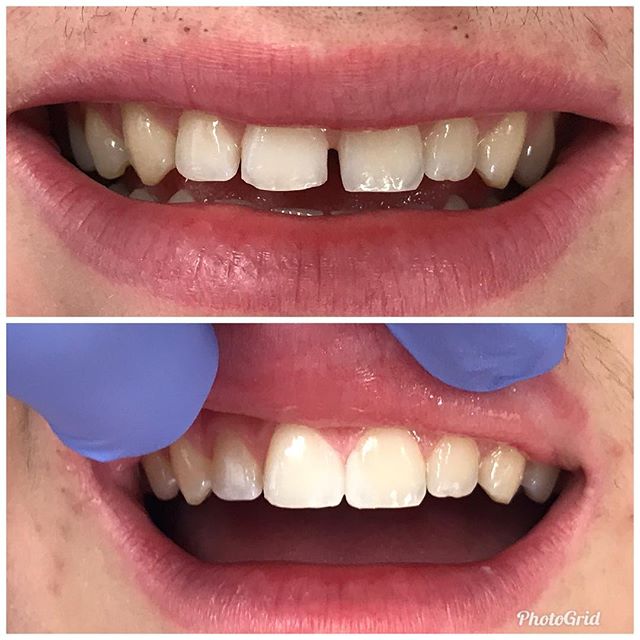 Showing a patient how to close spaces with bonding. We can show you, too, in about five minutes!  #DesignerSmilesByJudy #cosmeticdentistry #cosmeticdentist #frontteeth #whiteteeth #spaces #gaps #smiles #bonding