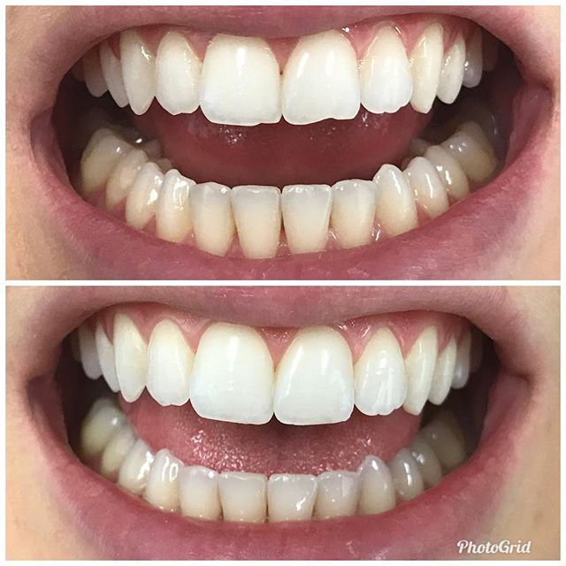 Another 5 minute smile makeover. How awesome is that?  #DesignerSmilesByJudy #cosmeticdentist #cosmeticdentistry #dentist #frontteeth #bonding #smiles #whiteteeth #veneers