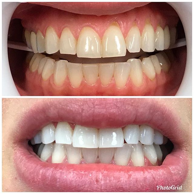 Incredible results with our new in-office whitening system.  #DesignerSmilesByJudy #teethwhitening #cosmeticdentistry #cosmeticdentist #whitening #whiteteeth #smiles