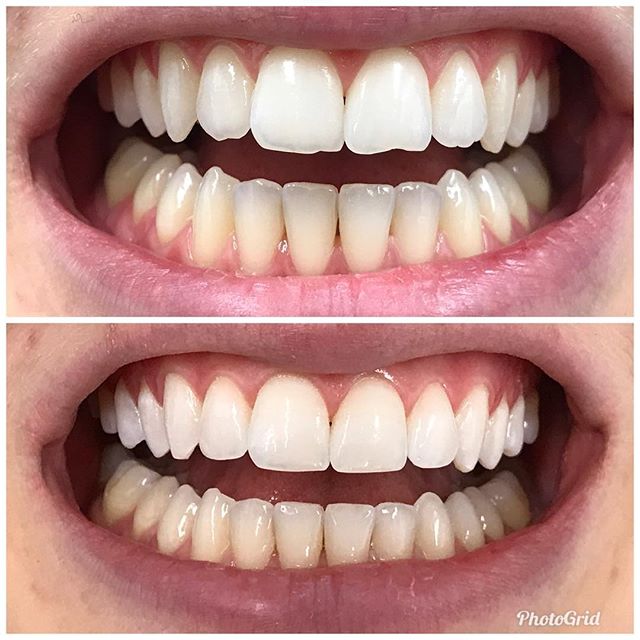 Bonding to even out all four front teeth. Color match=perfection.  #DesignerSmilesByJudy #cosmeticdentistry #dentist #whiteteeth #frontteeth #bonding #smiles #smilemakeover