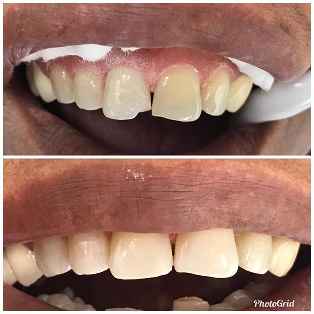 Front tooth bonding. Perfect shade match. Happy Patient  #DesignerSmilesByJudy #cosmeticdentistry #dentist #frontteeth #bonding #smiles #teeth