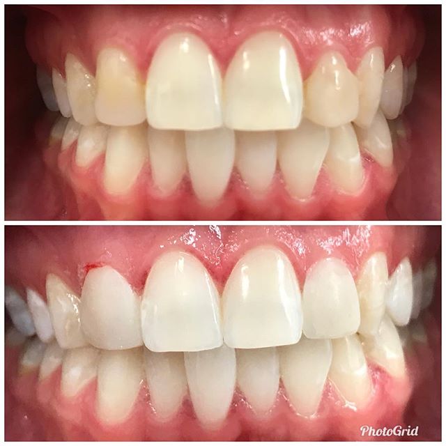Emergency bonding for this beautiful bride. Picture ready!
#DesignerSmilesByJudy #cosmeticdentistry #dentist #whiteteeth #bonding #smiles #cosmeticdentist