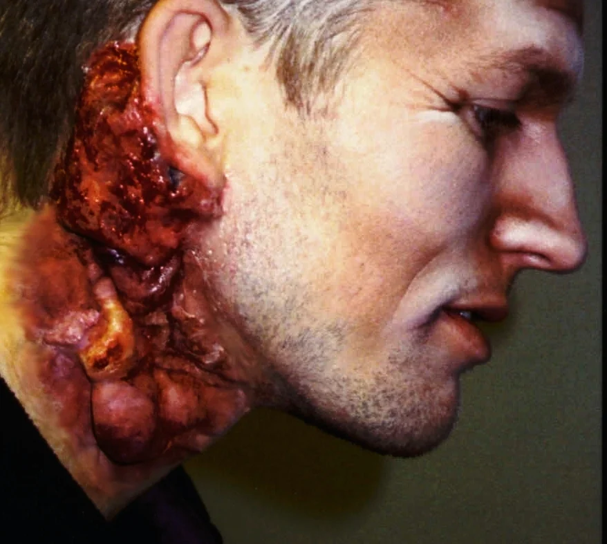 tumor.jpg