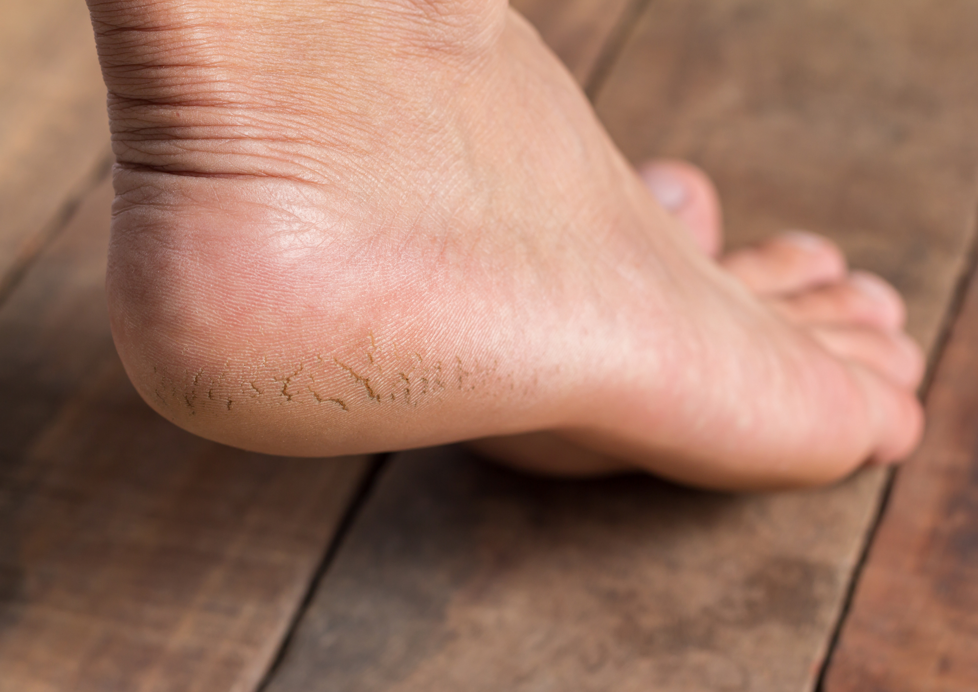Why Are My Feet Peeling? - Feet First Clinic