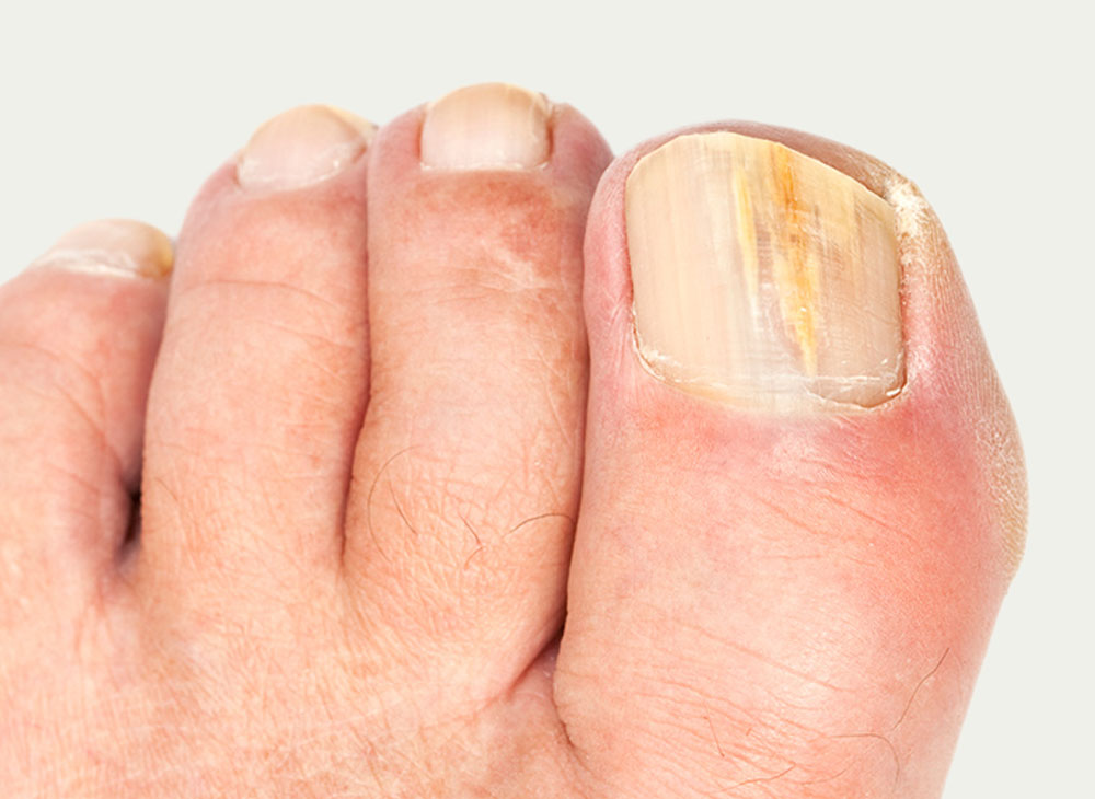 Toenail Fungus Laser Treatment in New Jersey (Clifton & Wayne)