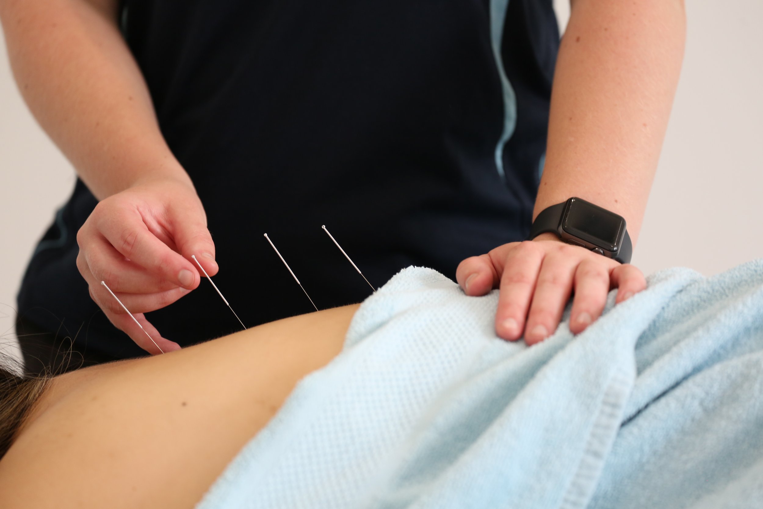 Dry Needling