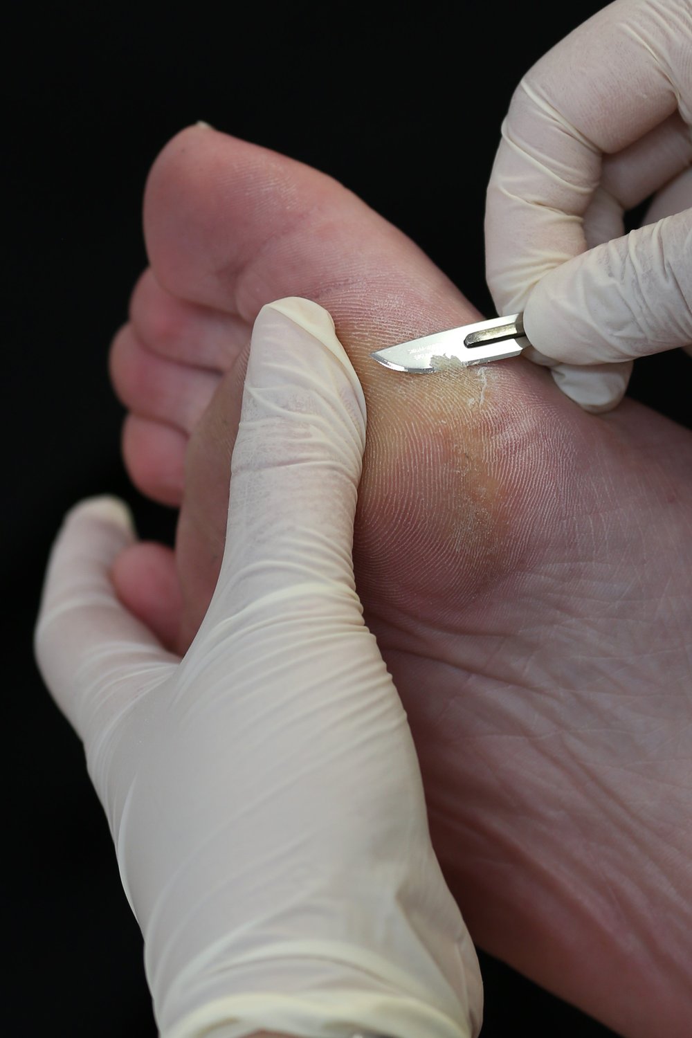 Skin & Nail Care (Dermatology) — 2 Right Feet Podiatry & Myotherapy | Yarra  Valley Family Podiatry & Remedial Massage