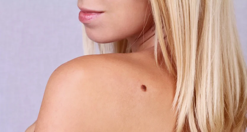 Keep moles under control