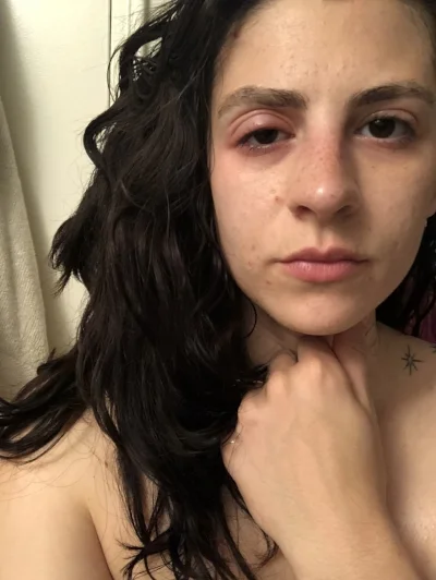 swollen-eyes-beofre.jpg