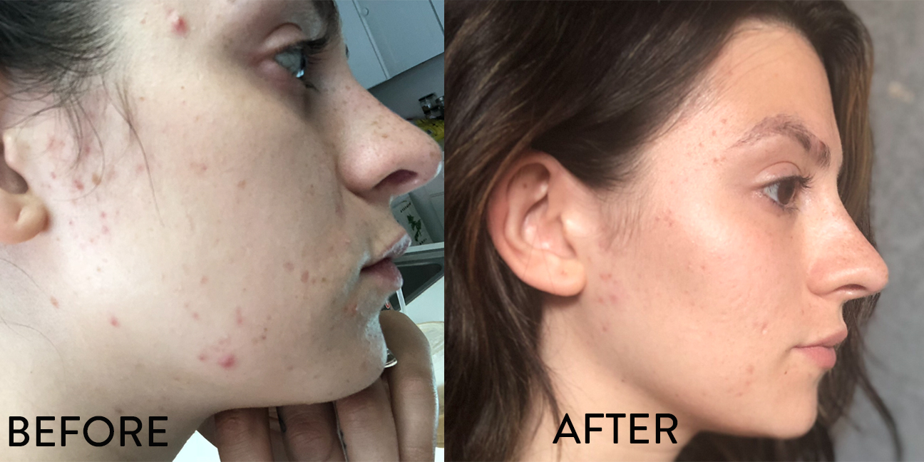 before-and-after-frankincense-oil-acne.jpg