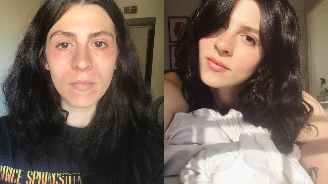 before-and-after-perioral-dermatitis.jpg