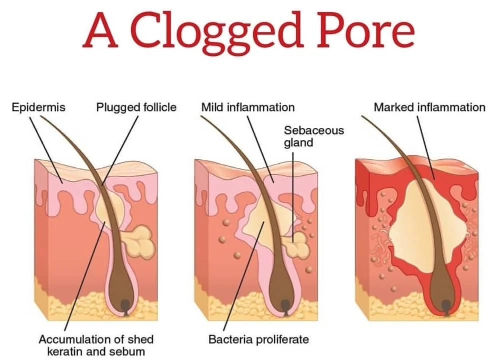 whats-in-a-clogged-pore.jpg