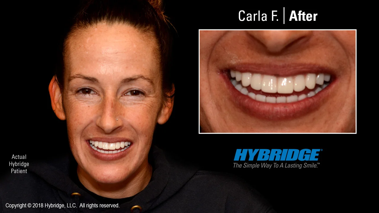 hybridge_carla_f_after.jpg