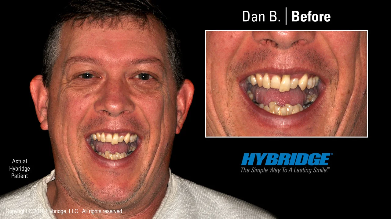 hybridge_dan_b_before.jpg