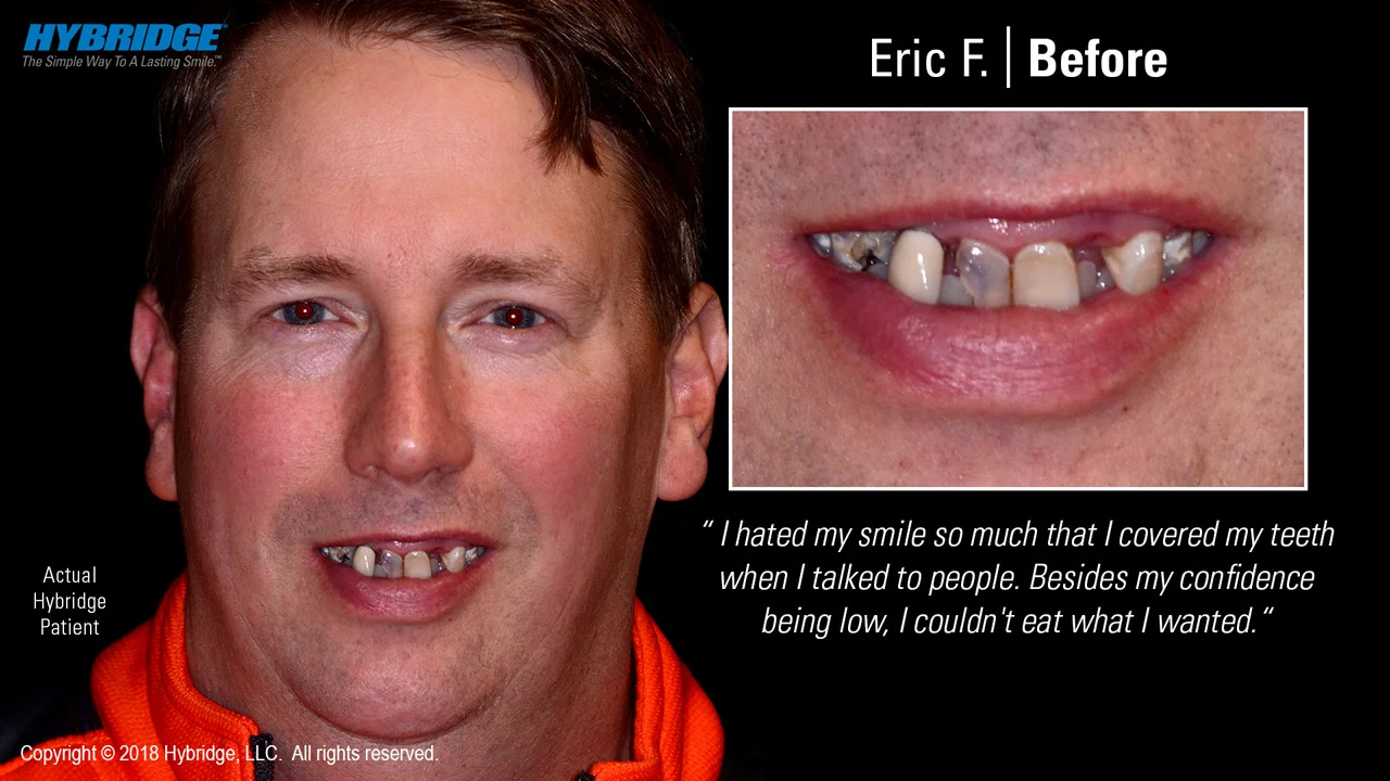 hybridge_eric_f_before.jpg
