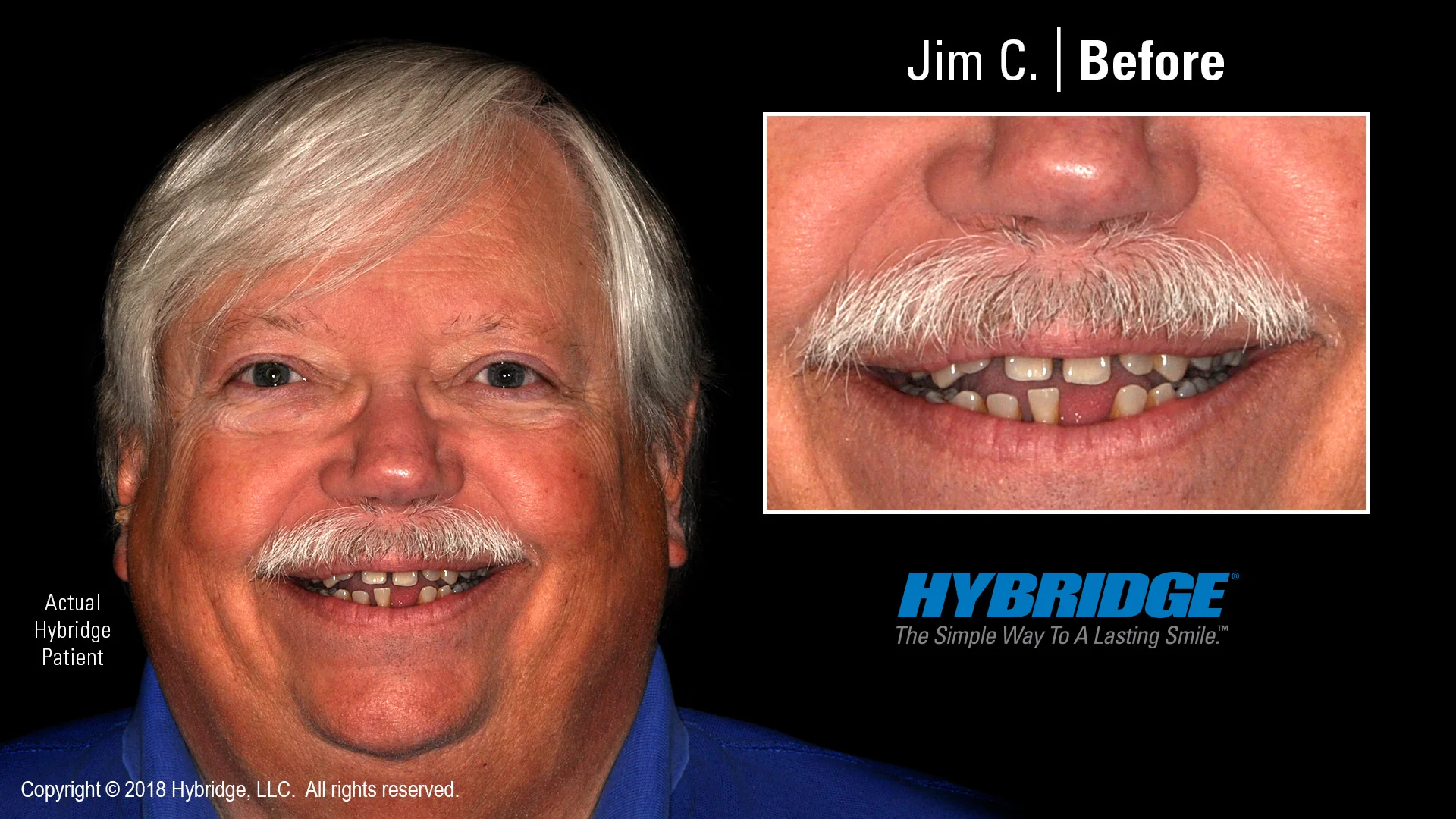 hybridge_jim_c_before.jpg