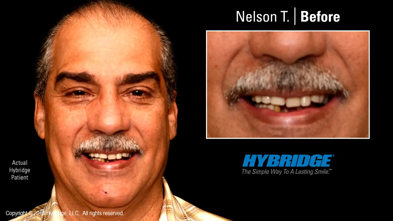 hybridge_nelson_t_before.jpg