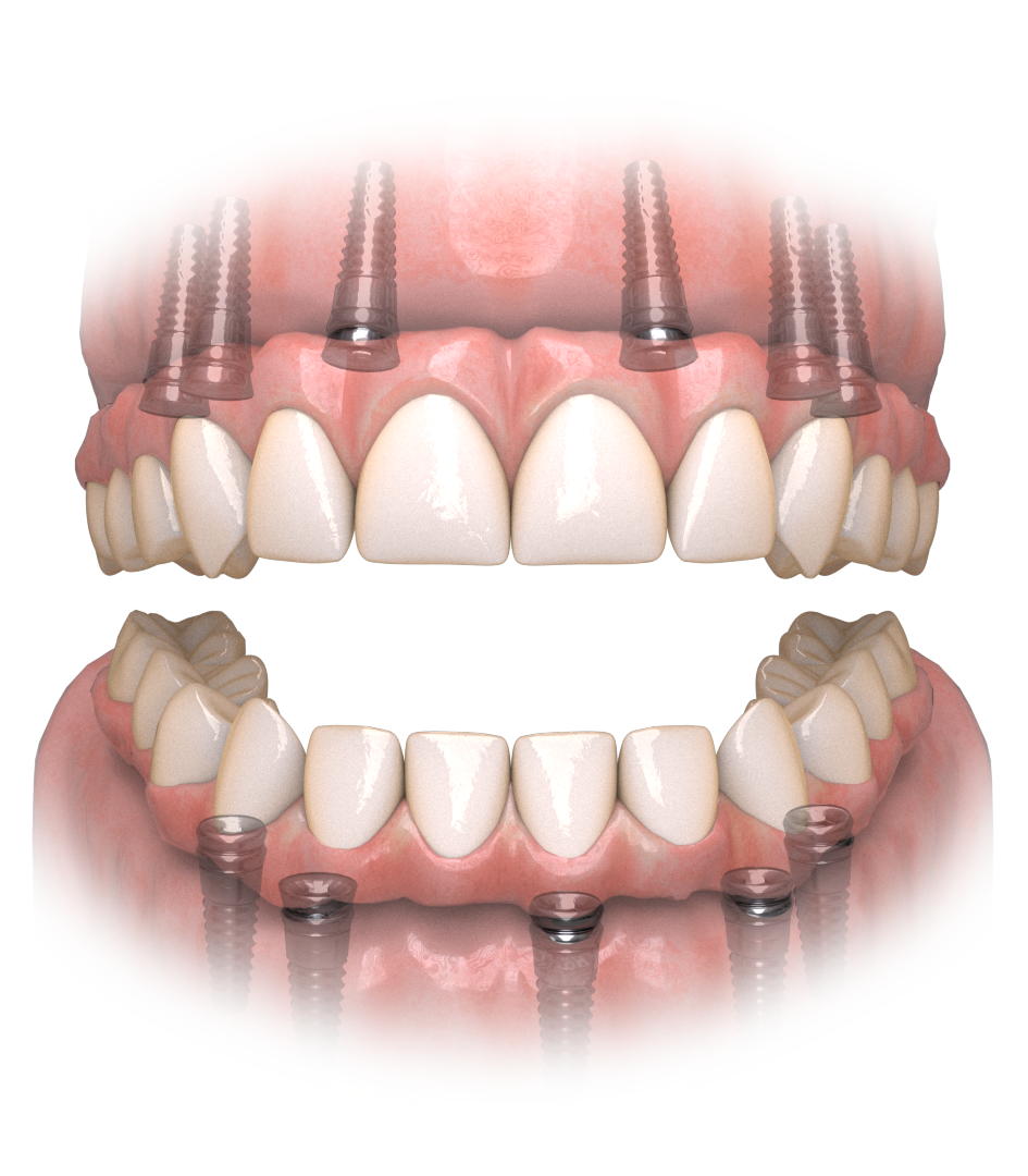 Hybridge_Teeth_Upper_Lower.png