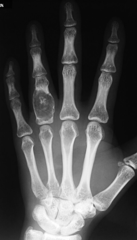 Enchondroma (Benign Tumour) Ring Finger