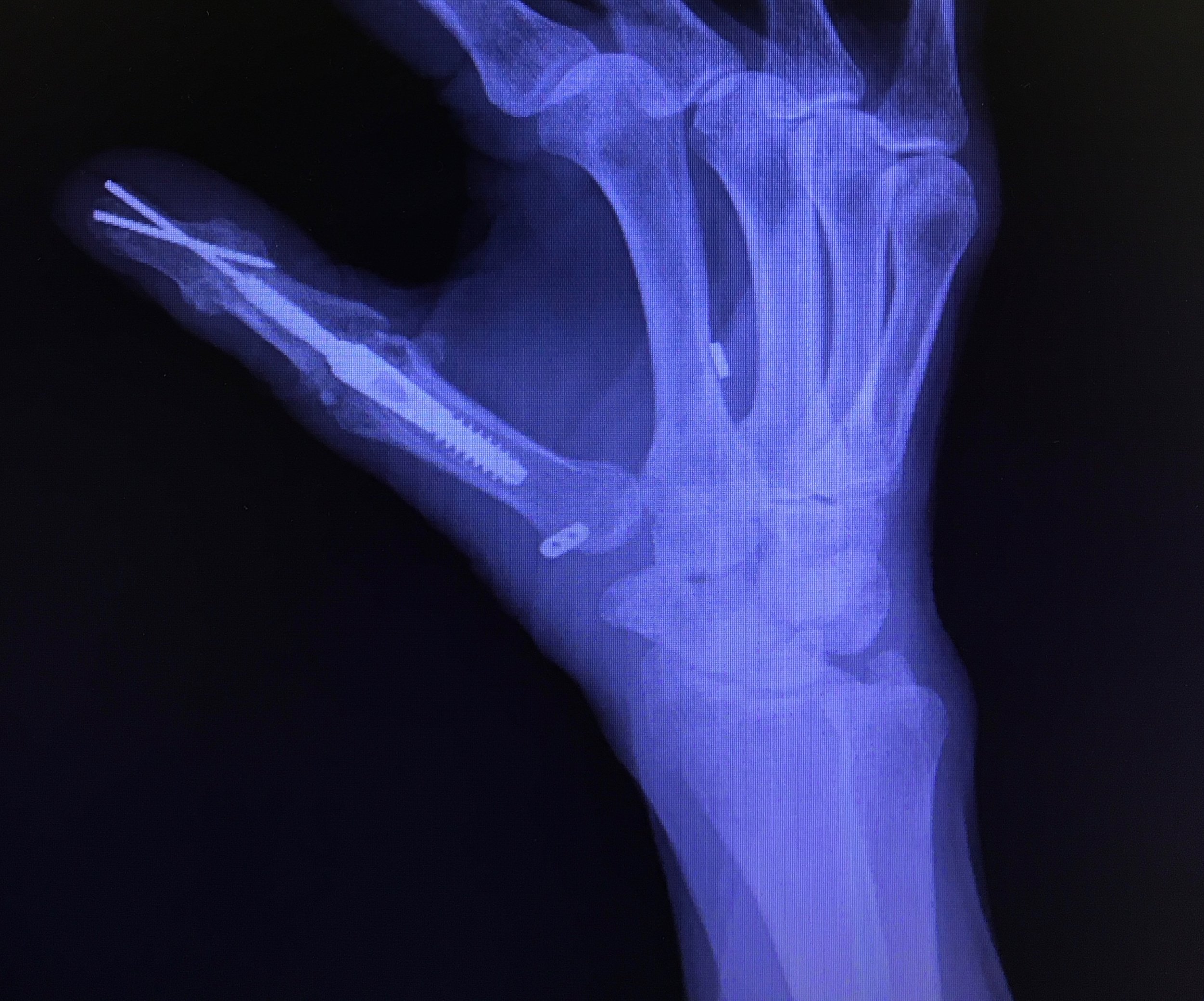 Postop - Arthritis Hand