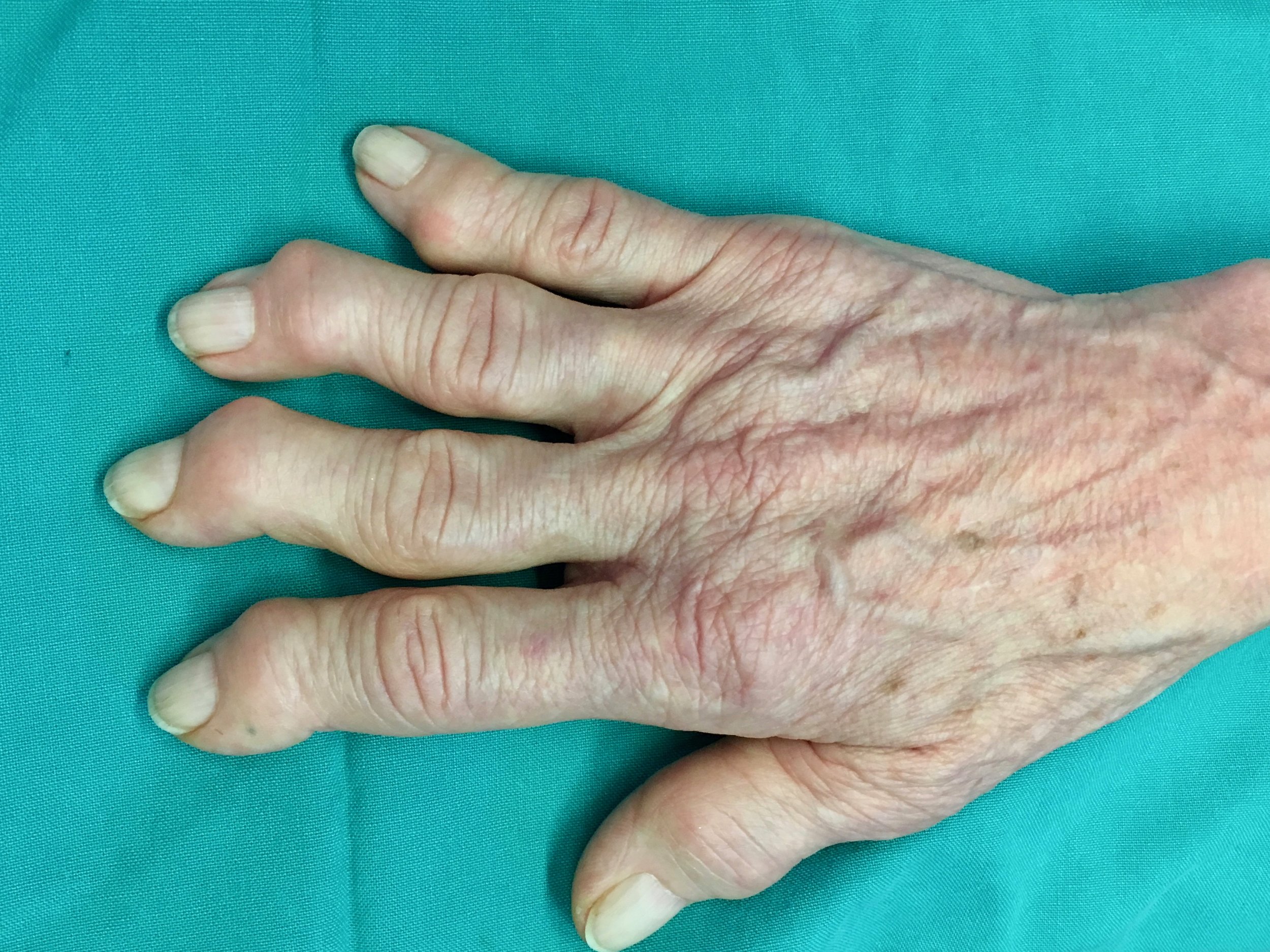 Arthritis Hand