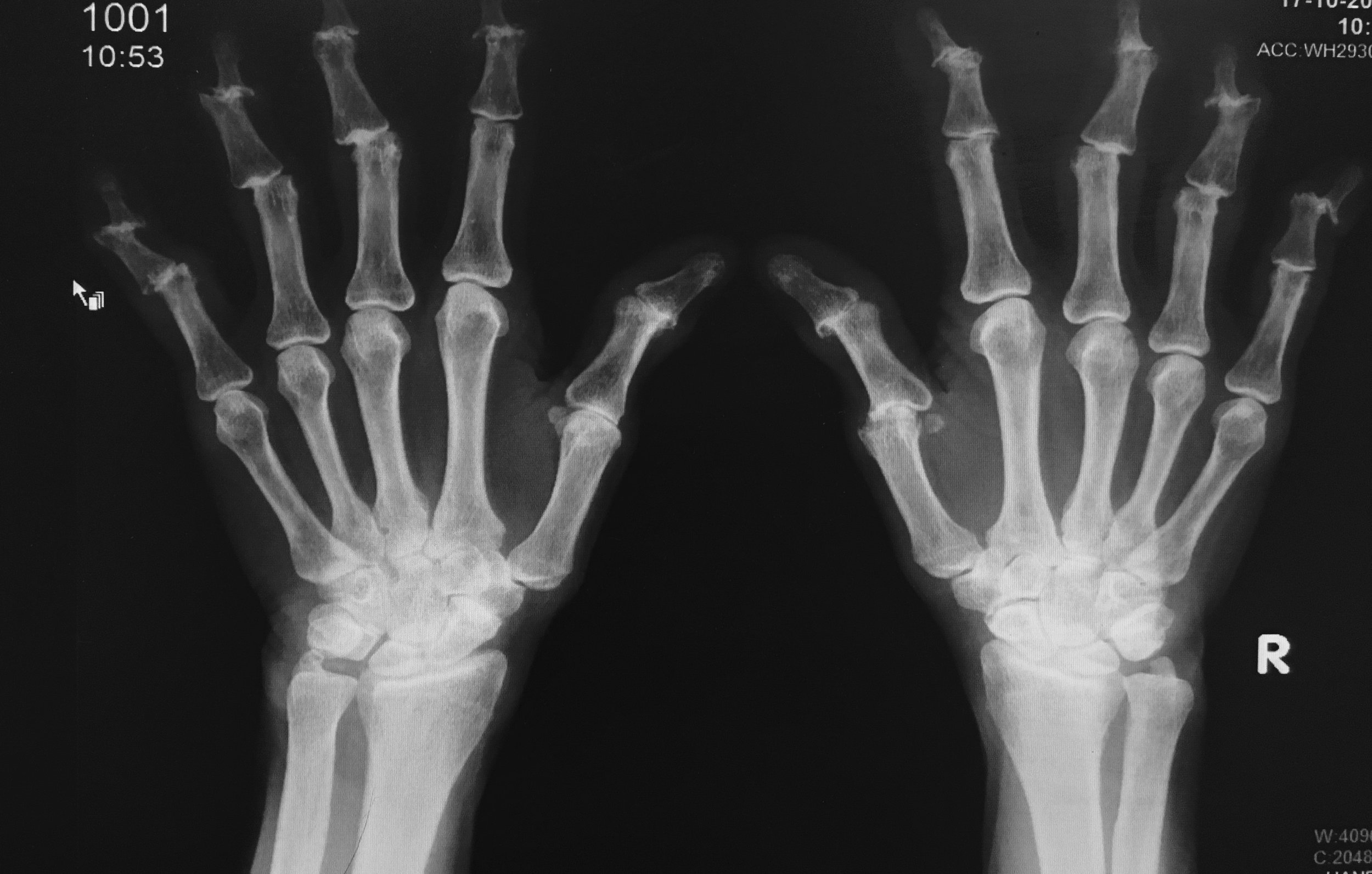 Xray - Arthritis Hand