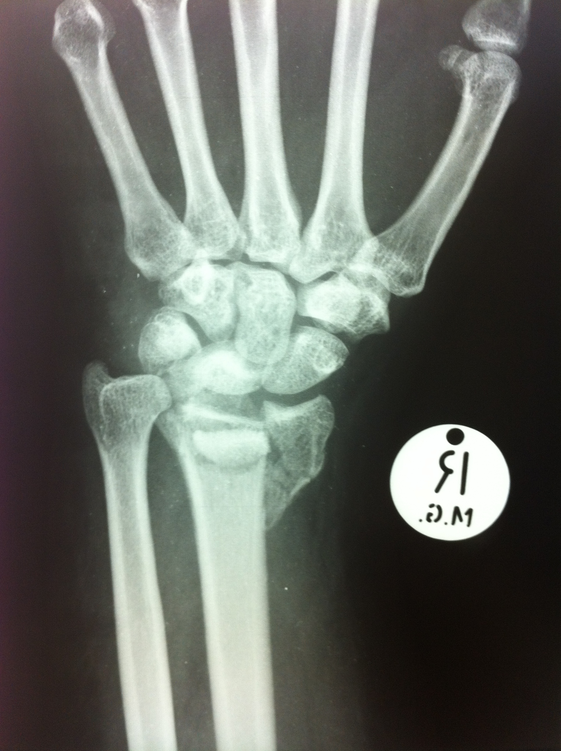 Xray - Pre-op radius fracture