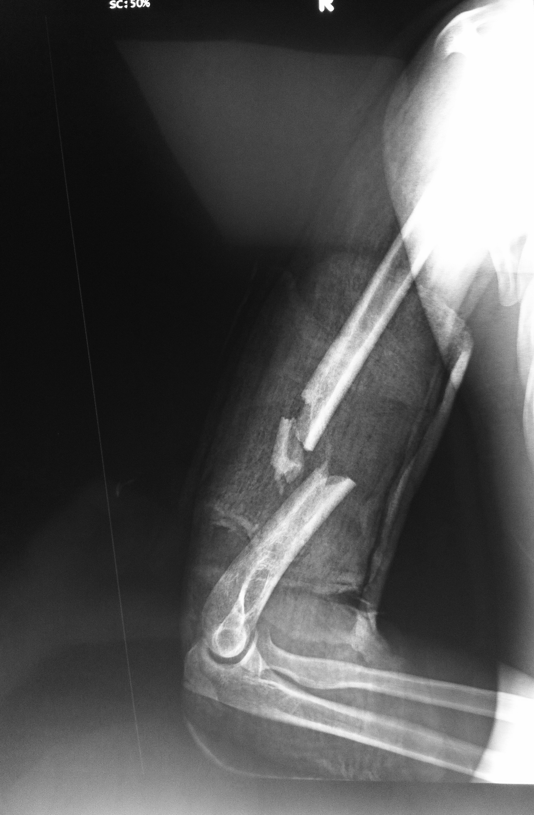 Postop Humerus Fracture 2