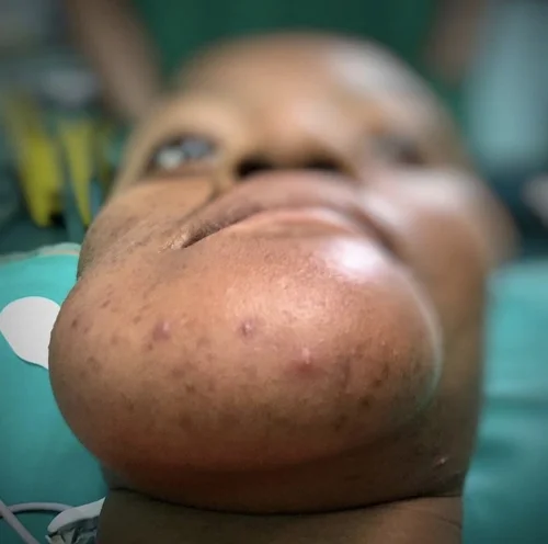 Tumors on right side of patient’s face