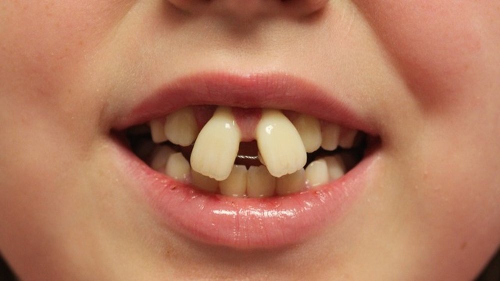 Harmful Effects Of Diy Braces The Unorthodoc - Fake Braces Diy Rubber Bands